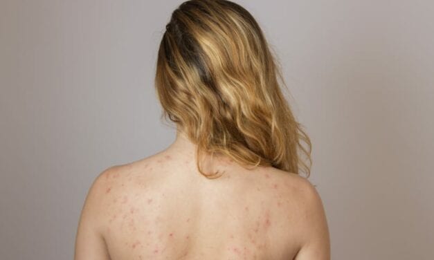 Why More People Are Getting Body Acne Than Ever