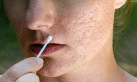 How to Fix Those Annoying Scars and Bumps Caused By Acne