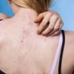 What Causes Back Acne?