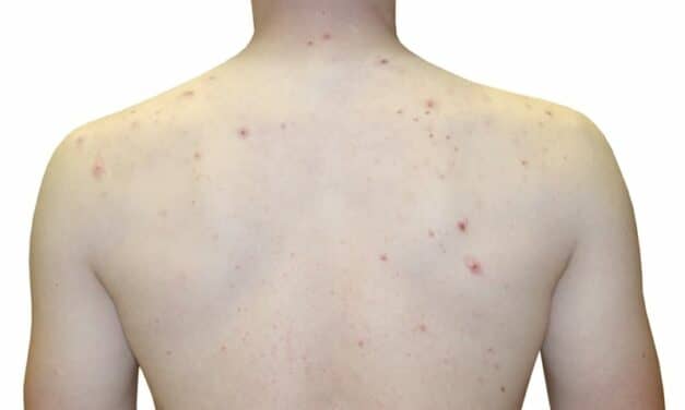 How to Treat Body Acne and Prevent Breakouts From Happening in the First Place