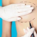 Establishment Labs Launches Preservé for Aesthetic Breast Augmentation in Brazil