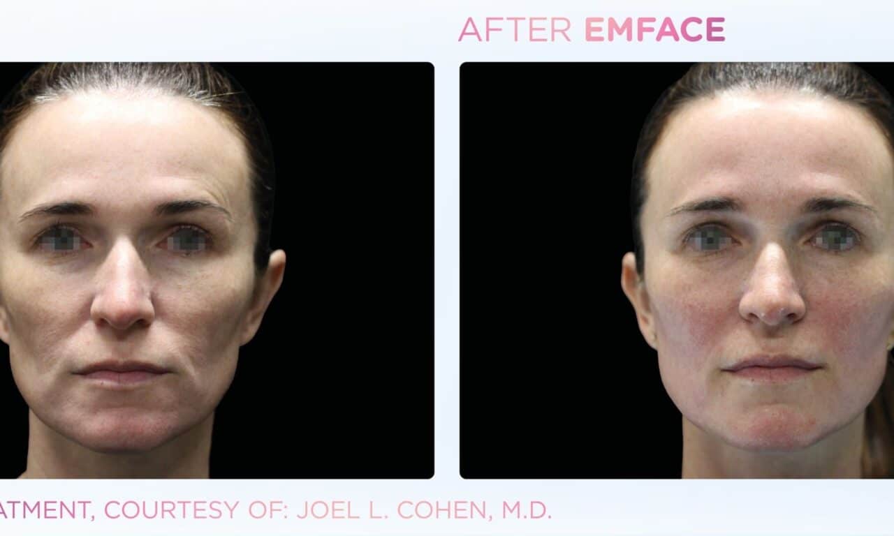 Non-Invasive Facial Lifting Procedure Emface Surpasses 1 Million Treatments 