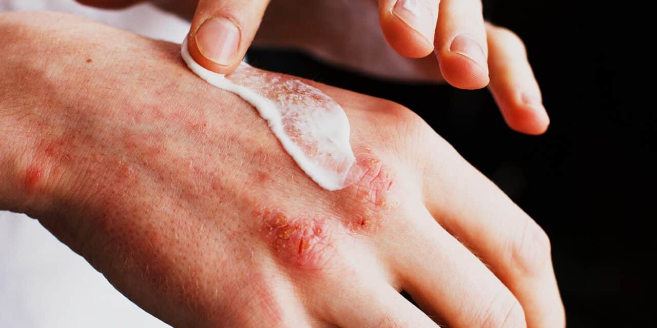 Investigational Cream Improves Chronic Hand Eczema Symptoms