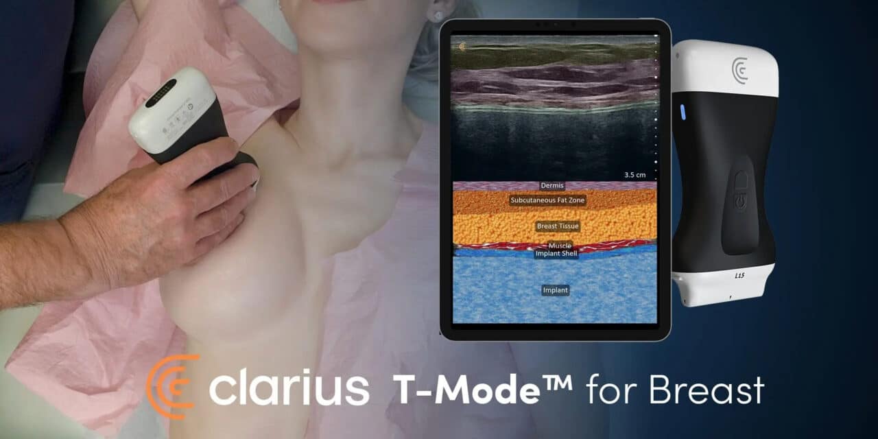 Clarius Launches AI-Powered T-Mode for Breast Ultrasound Training