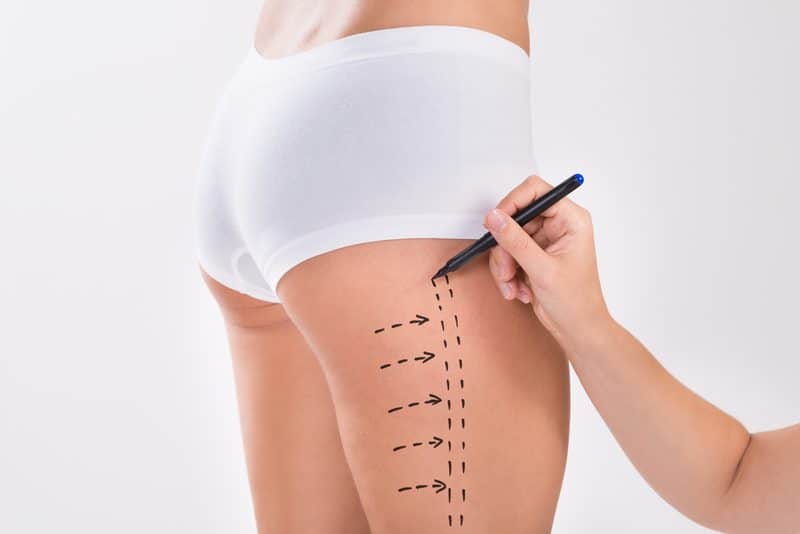Plastic Surgeon Offers Liposuction Training Course