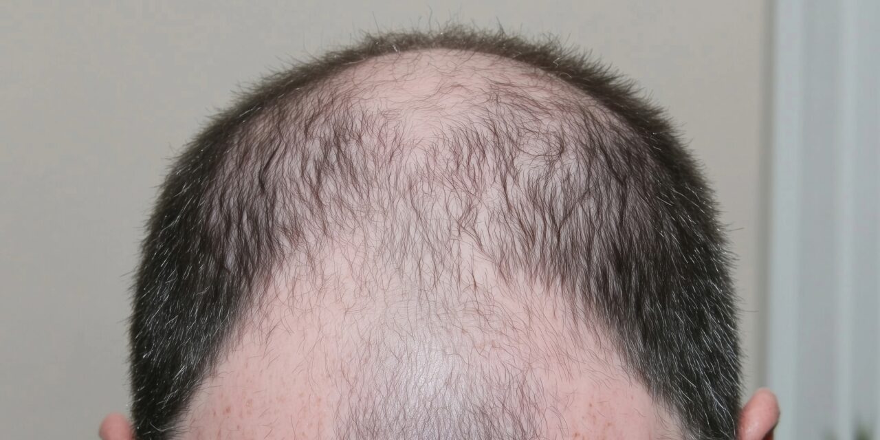 Dr J. Epstein Launches Hair Restoration Method Through Inspire Aesthetics Group