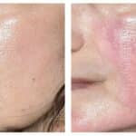 Beverly Hills Plastic Surgeon to Offer ADVATx Dermatology Laser