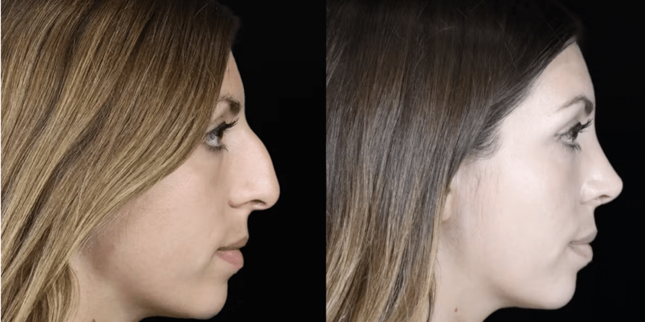 Nerve Block Innovation: Reducing Pain in Rhinoplasty